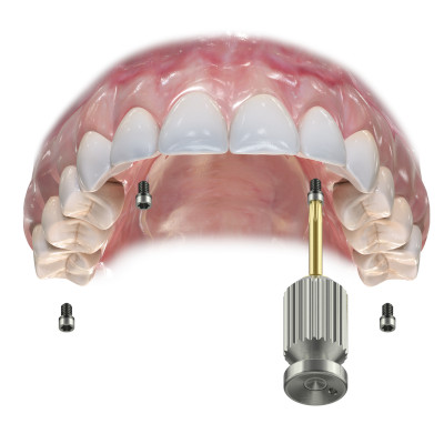 implant unitaire