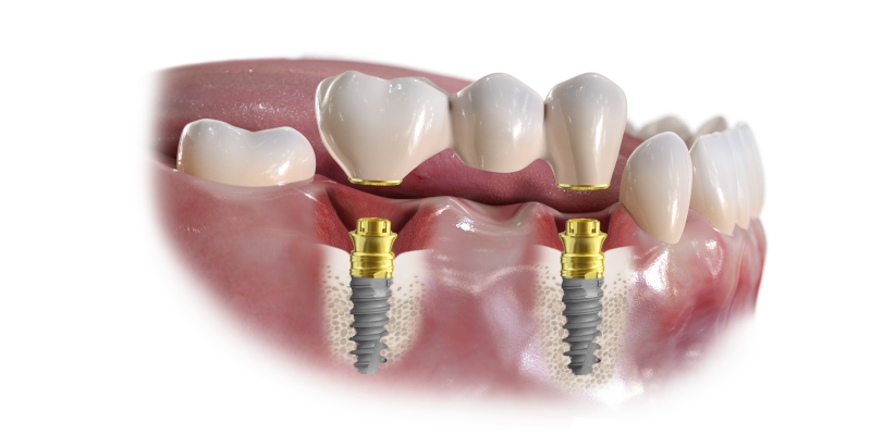 implant unitaire